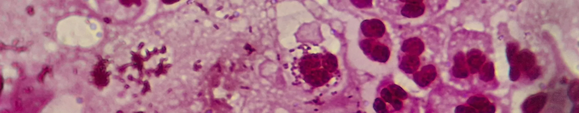 Gonorrea: ¿Qué es y cuáles son sus síntomas? - Nosotras 